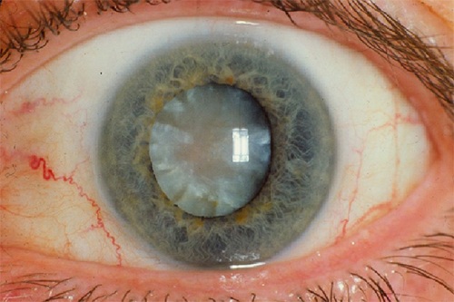 cataract in eye