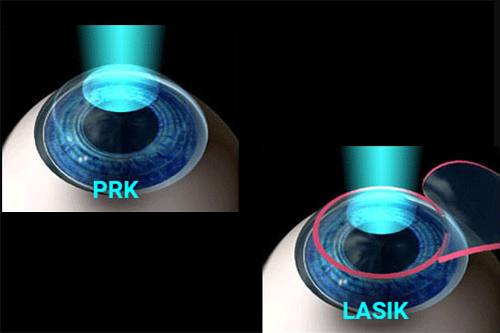 comparison of PRK and LASIK on eye